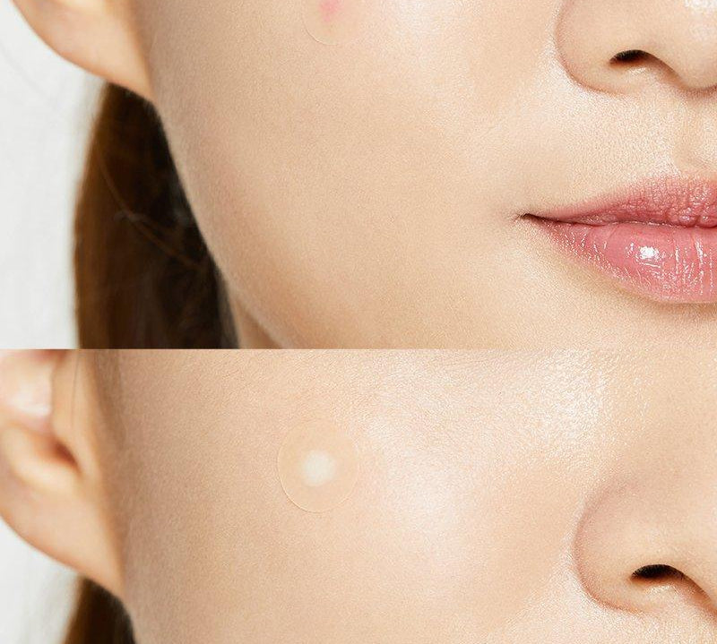 acne-pimple-master-patch-cosrx-official-5_1296x_a169a522-d701-4509-975b-e472acbfc4f9.jpg