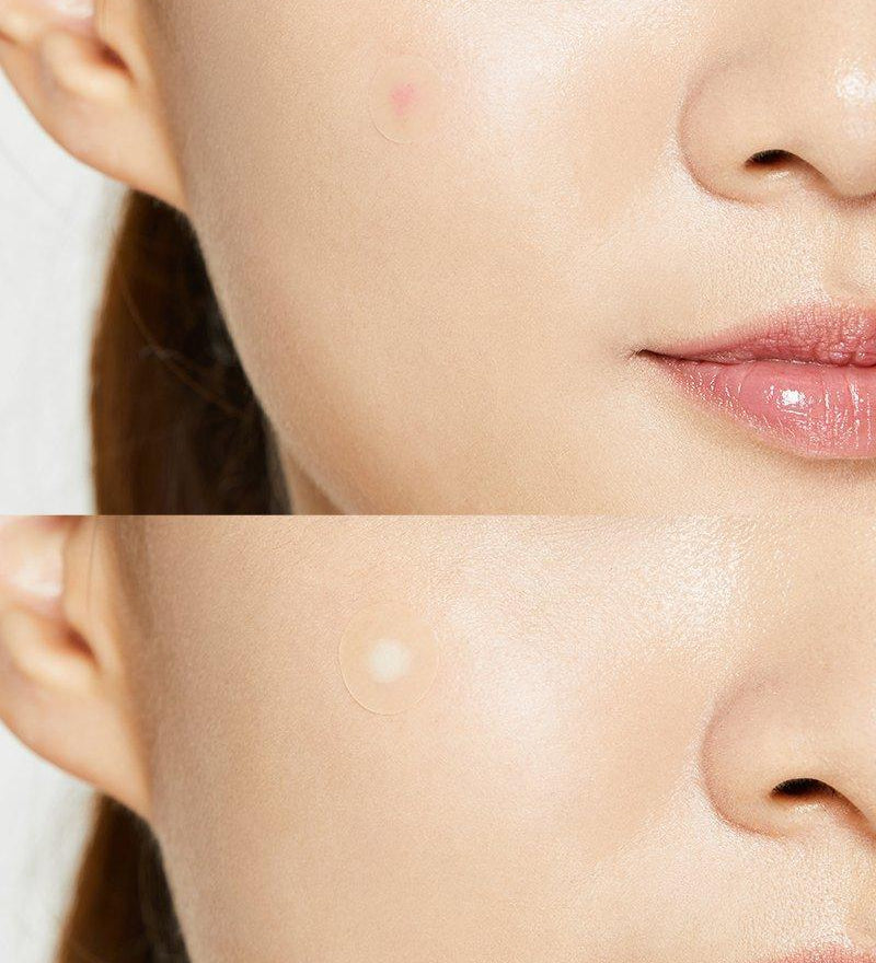 acne-pimple-master-patch-cosrx-official-5_1296x_a169a522-d701-4509-975b-e472acbfc4f9.jpg